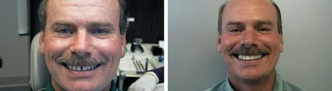 An actual patient of Bjorklund Dental Designs, before and after treatment.
