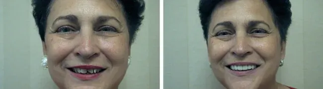 An actual patient before and after her teeth were straightened in under a month.