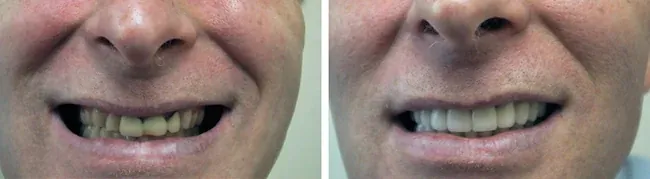 A full mouth makeover, before and after, at the Wayzata practice.