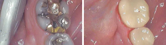 A CEREC case at Bjorklund Dental Designs, before and after, completed in one appointment.